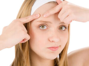 Come curare l’acne giovanile
