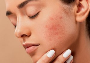 come curare l’acne